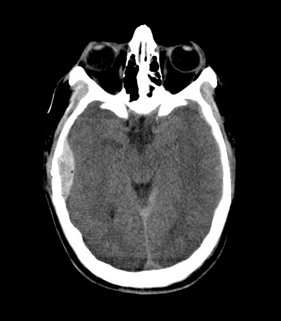 Extradural haematoma,MRI scan