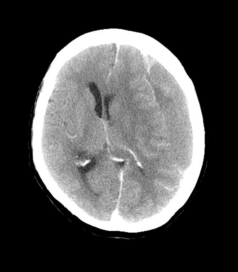 Subdural haemorrhage,MRI scan