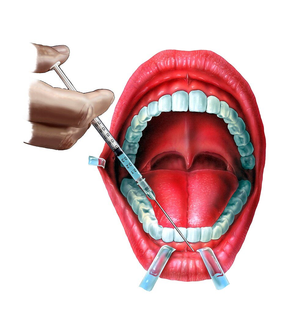 Dental anaesthesia,artwork