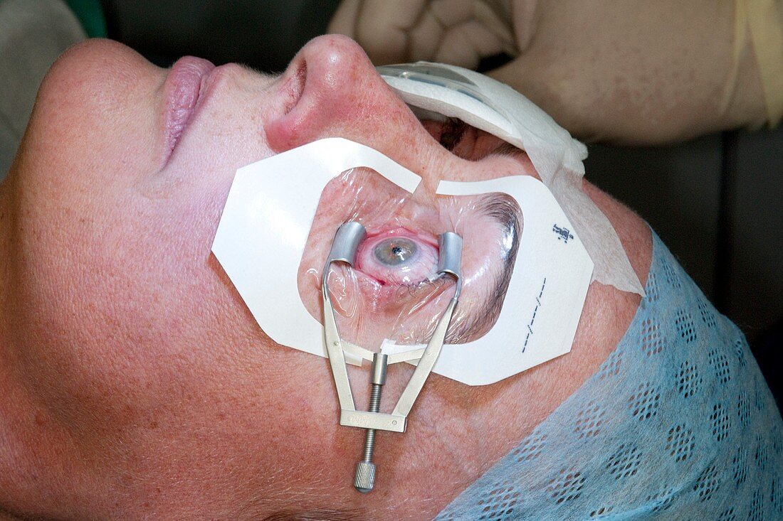 Laser eye surgery