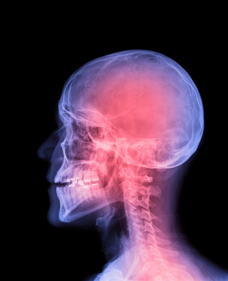 Human head,X-ray