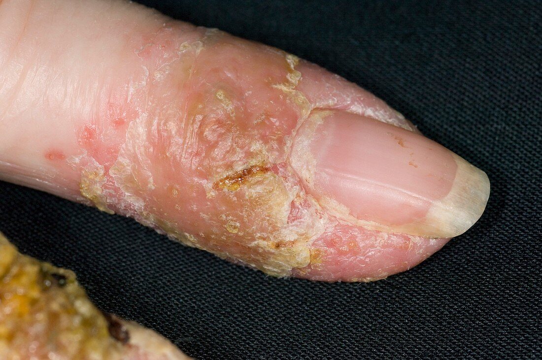 Infected eczema on the fingers