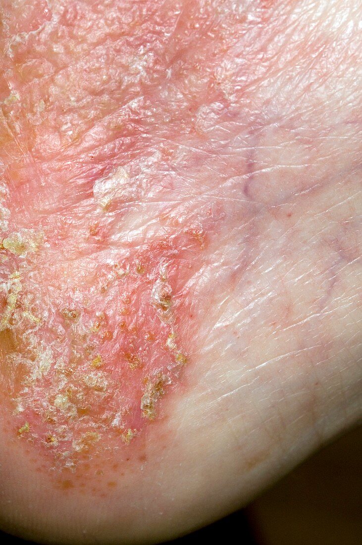 Infected eczema on the foot