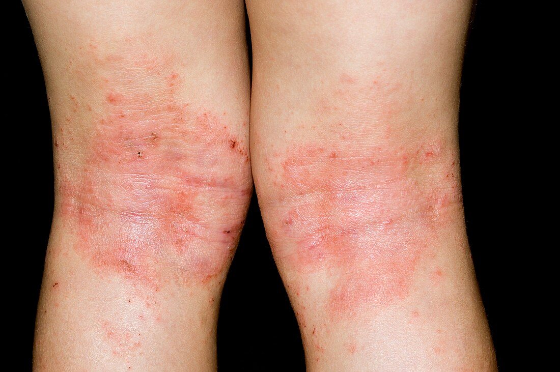 Atopic eczema on back of knees