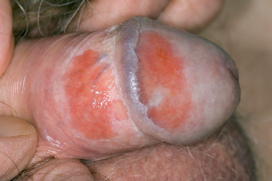 Balanitis of the penis
