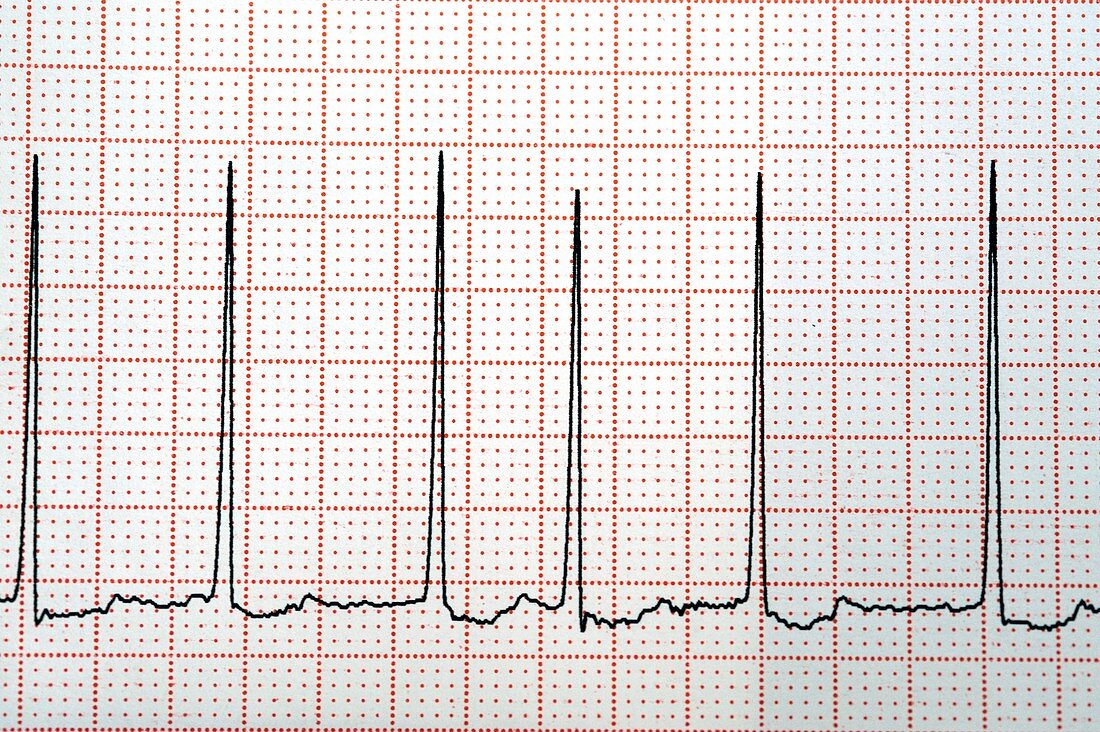 Atrial fibrillation of the heartbeat