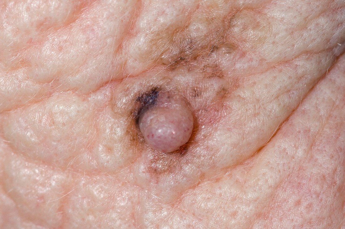 Skin cancer on the cheek
