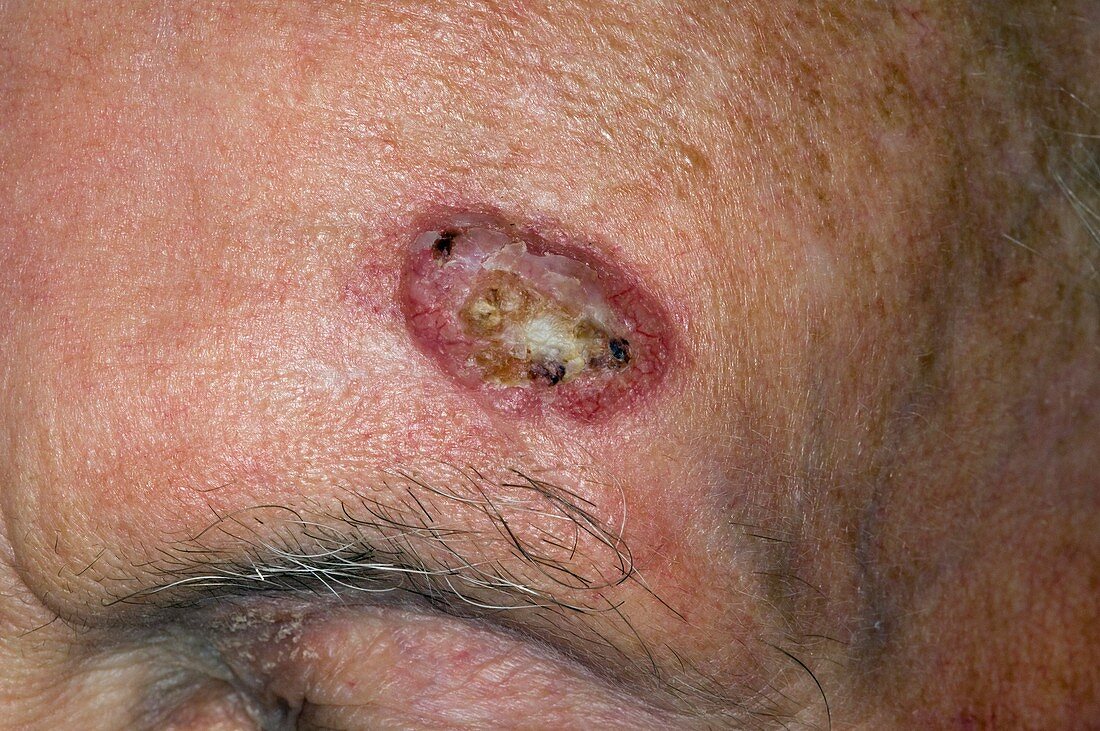 Skin cancer on forehead
