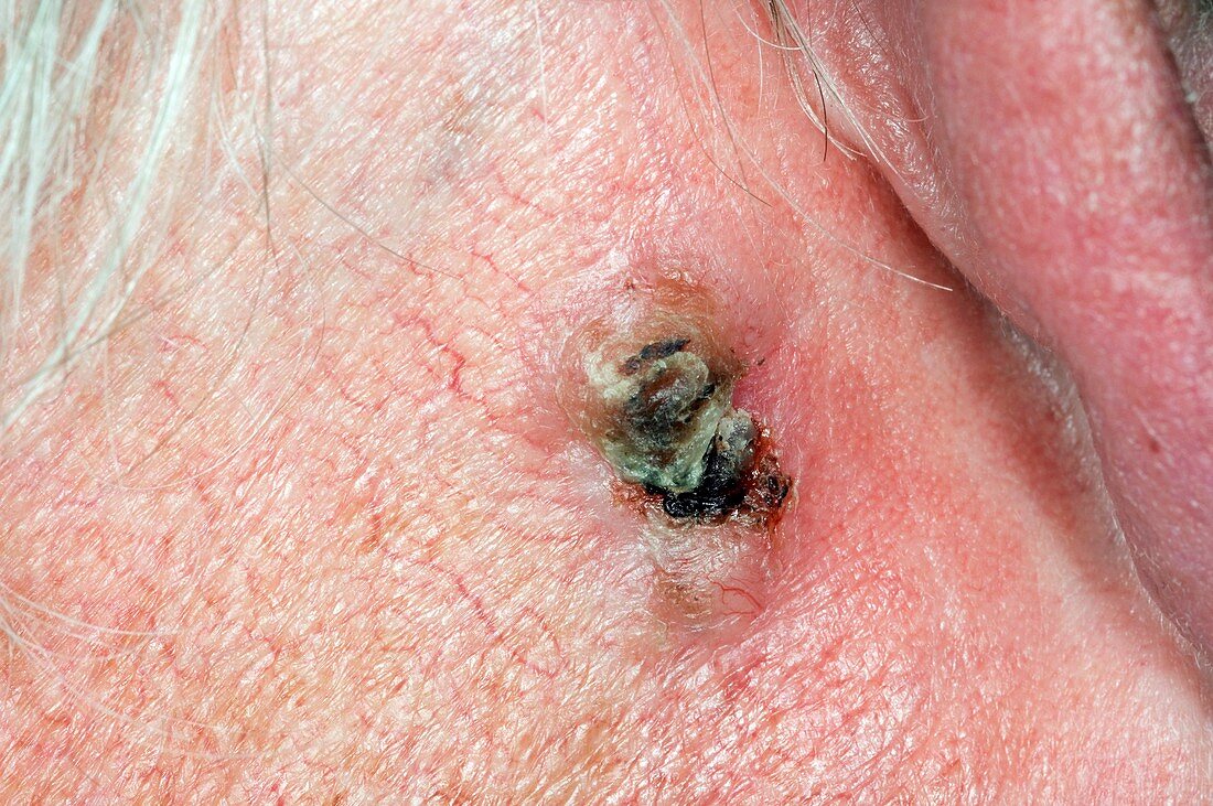 Skin cancer behind the ear