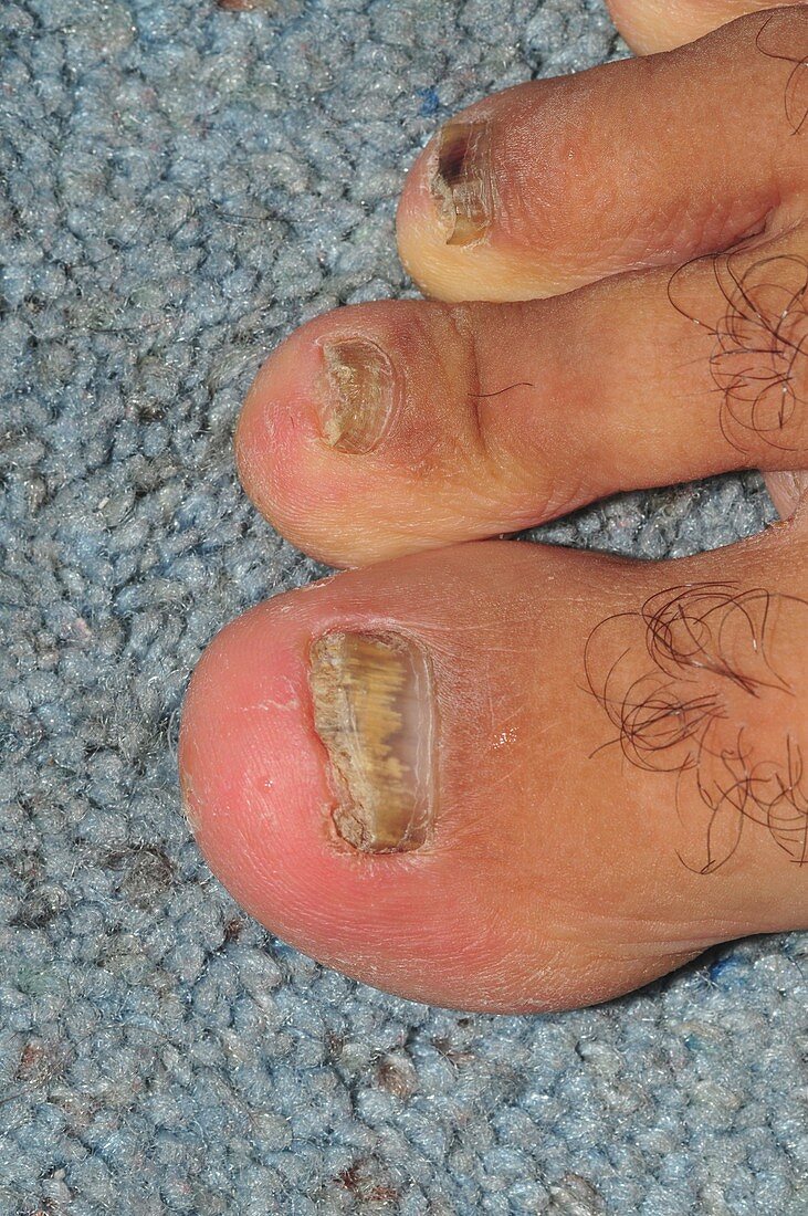 Fungal infection in toenails