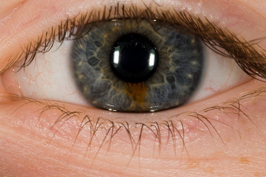 Naevus in the iris of the eye