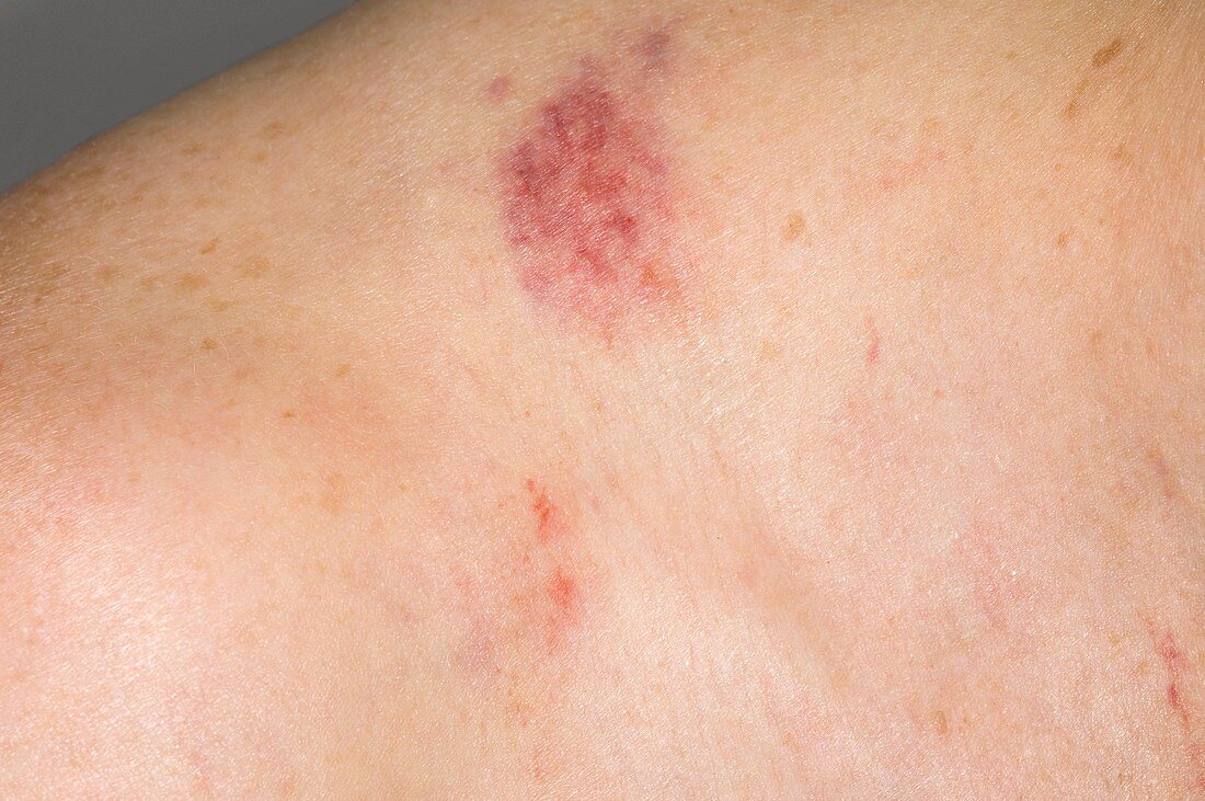 Bruised shoulder from car seatbelt
