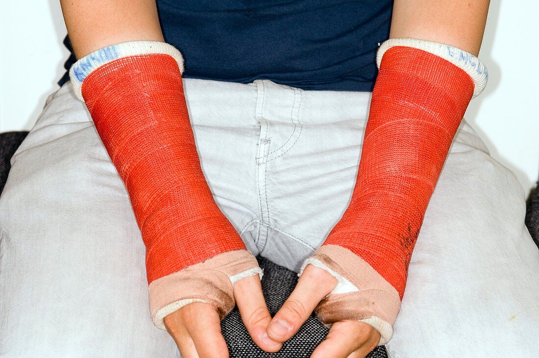 Broken wrists in plaster casts