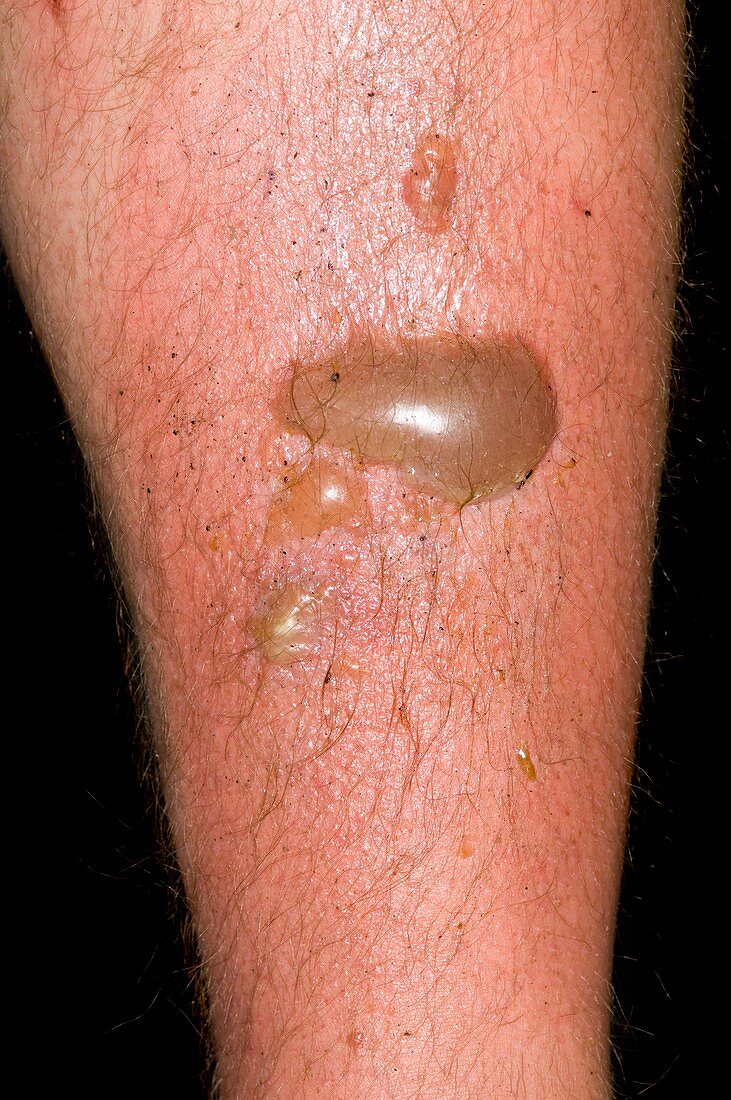 Burns on the leg from boiling water