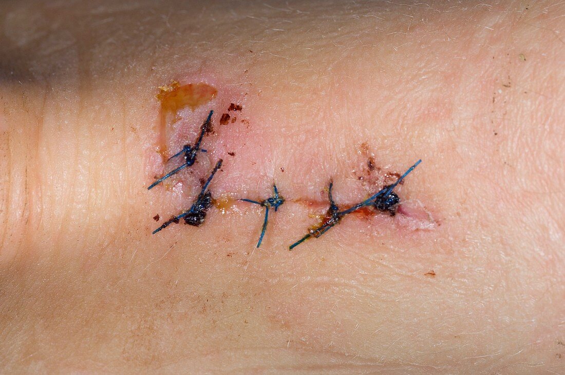 Sutures closing a heel laceration