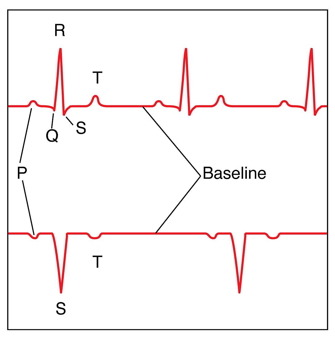 ECG of a normal heart rate,artwork