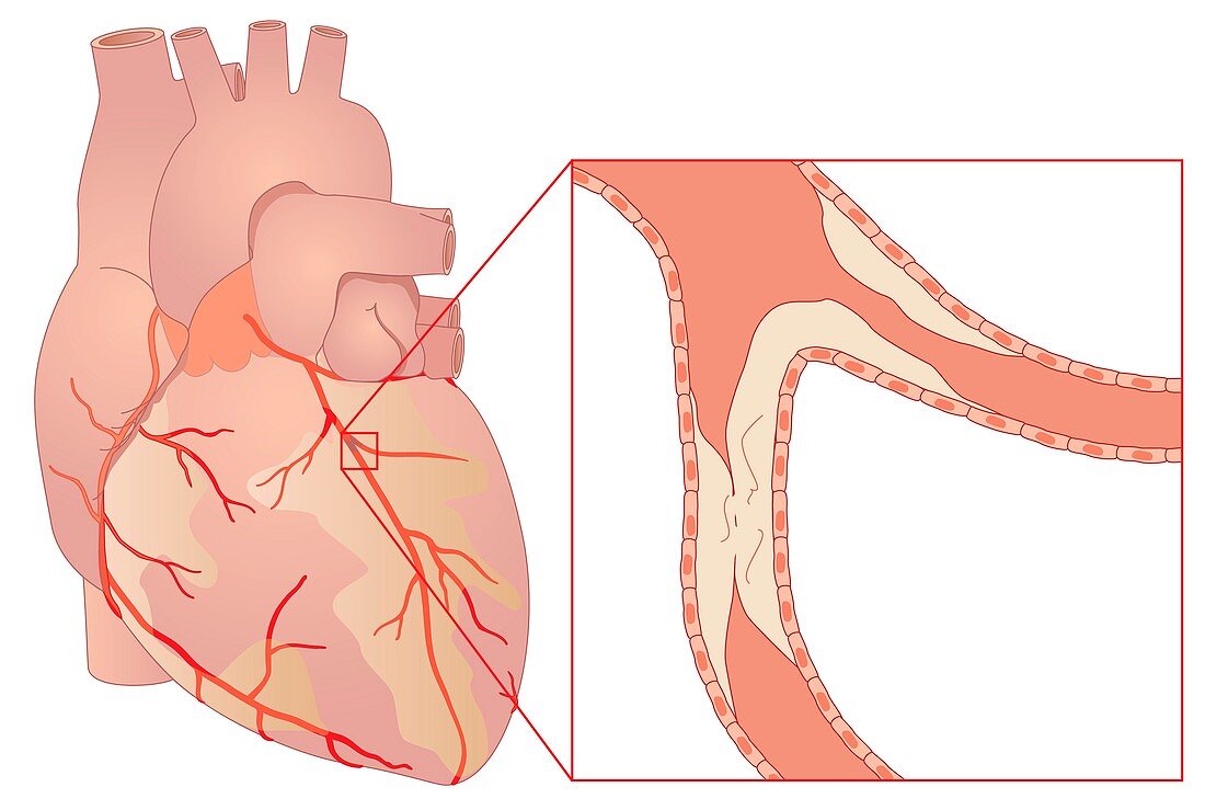 Narrowed coronary artery,artwork