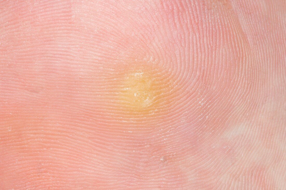 Abscess on the sole of the foot