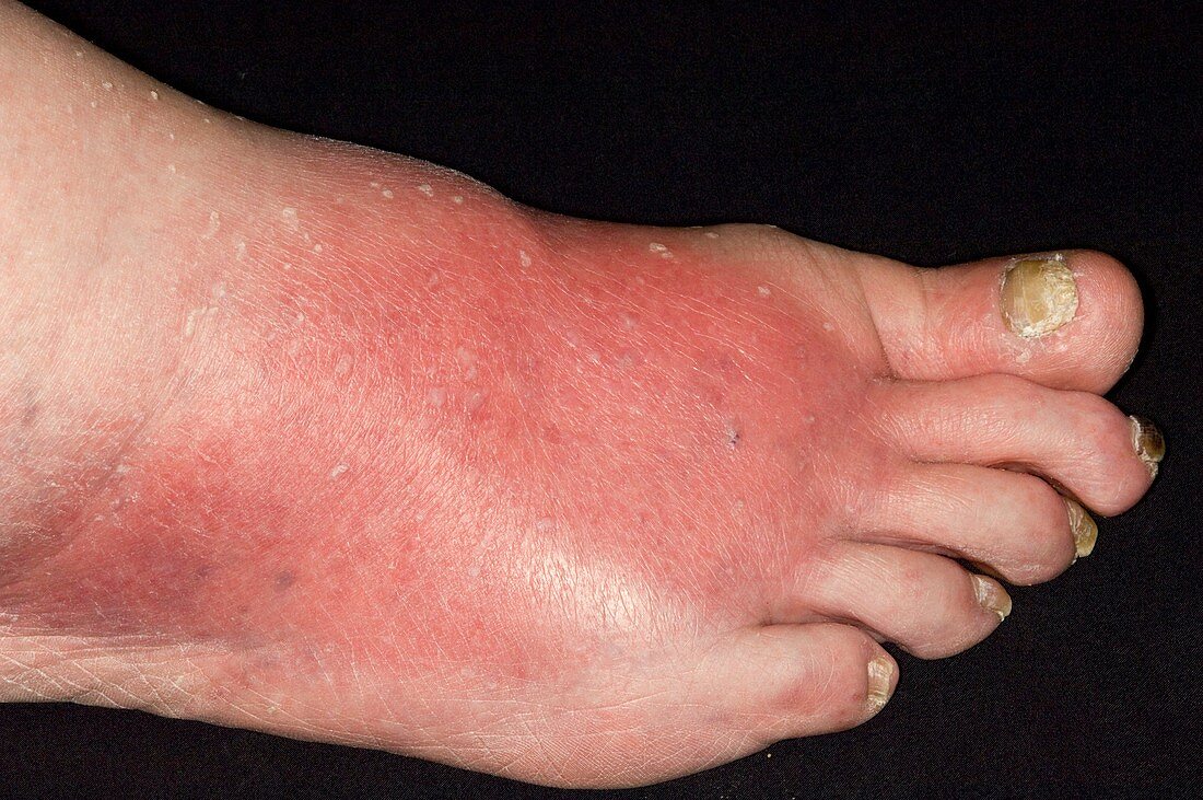 Cellulitis infection of the foot