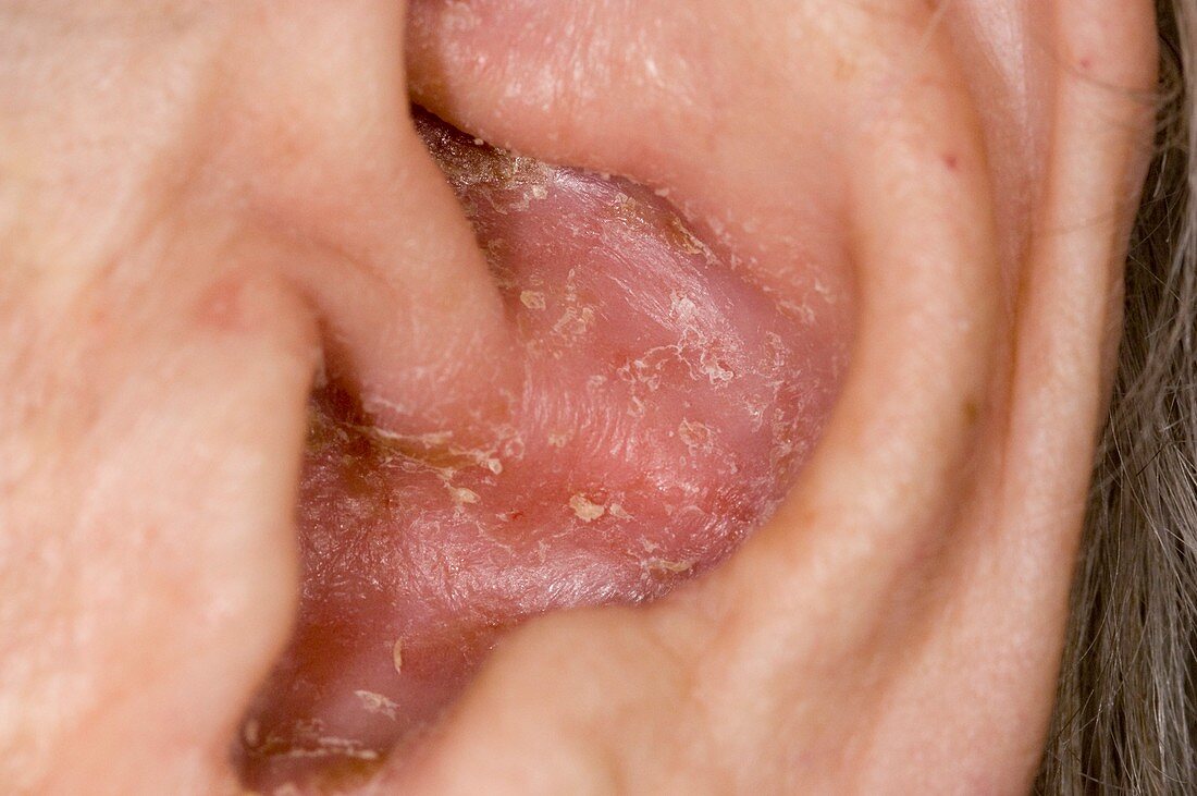 Infected outer ear (otitis externa)