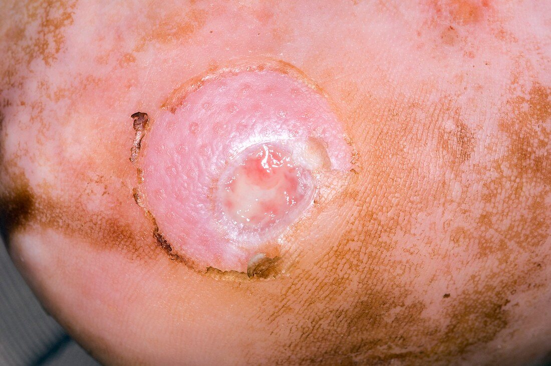 Ulcer on the heel of the foot