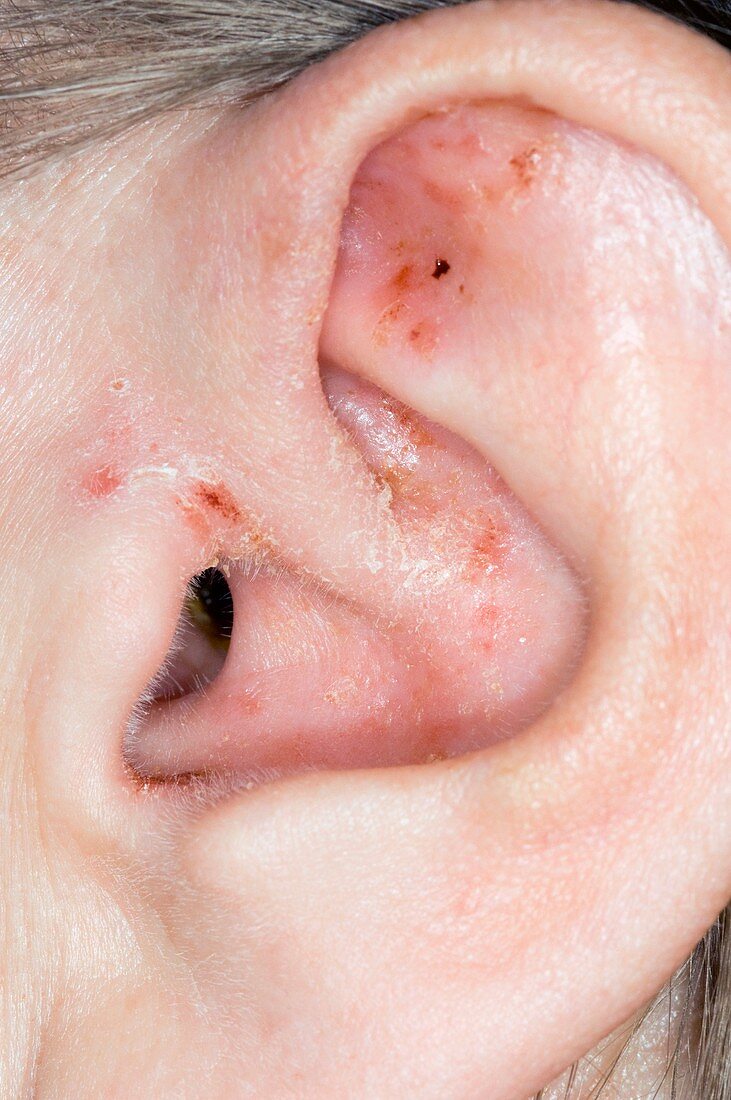 Eczema on the ear