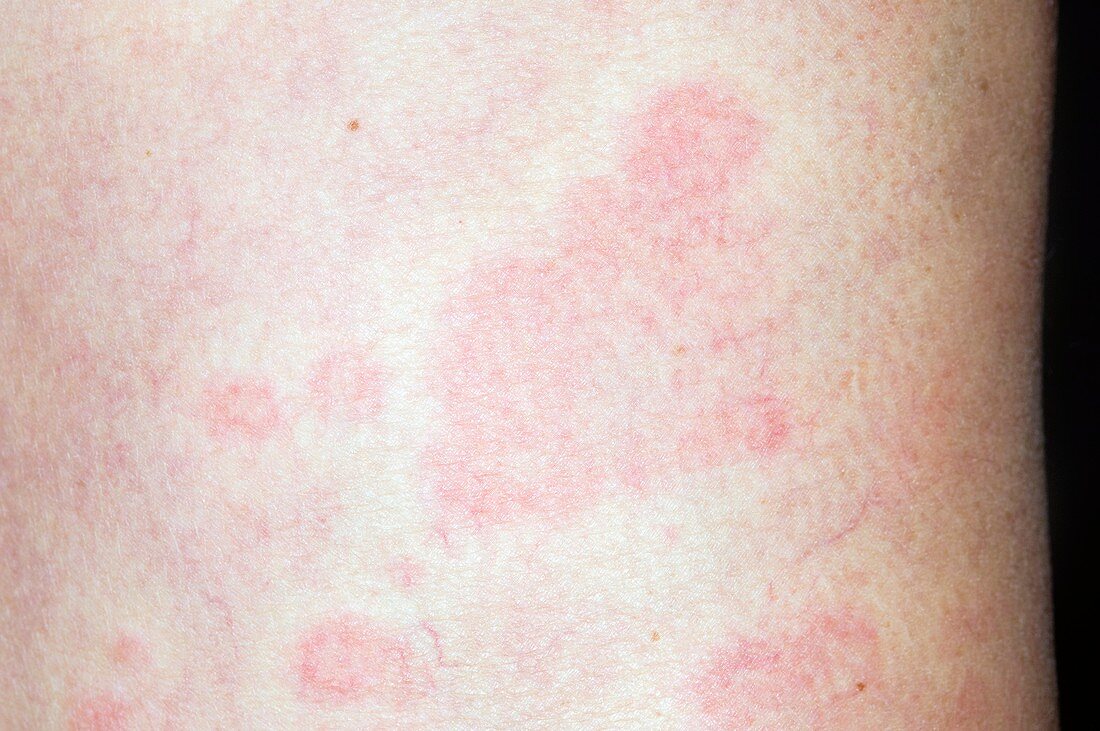 Urticaria (hives) on the body