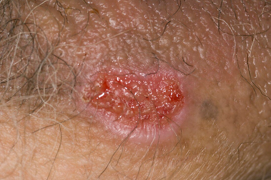 Genital ulcer from drug reaction