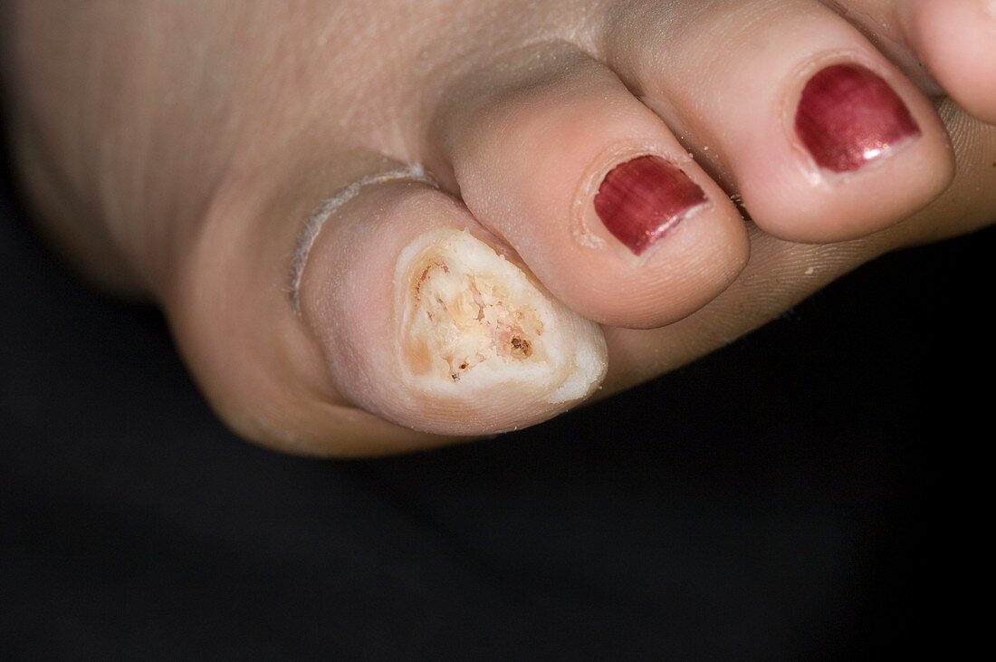 Loss of toenail in fungal infection