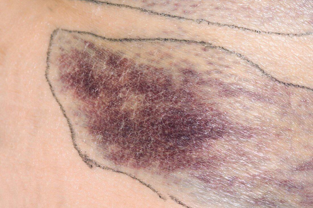 Bruising due to heparin injection