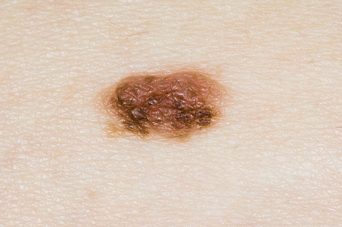 Intradermal naevus on the skin