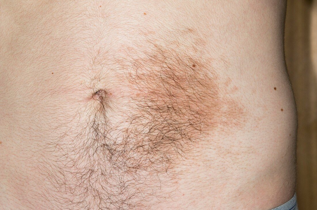 Becker's naevus on the abdomen