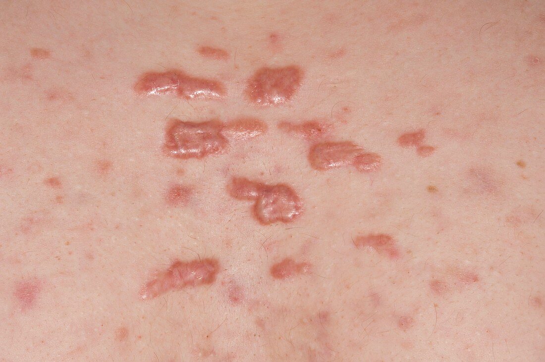 Keloid scars in acne vulgaris