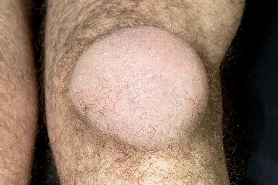 Pre-patellar bursitis in the knee