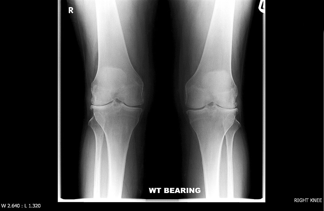 Knees before replacement surgery,X-ray