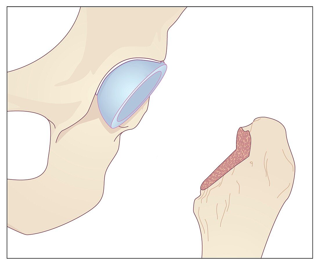 Hip replacement,artwork