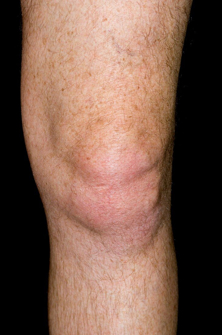 Gout of the knee