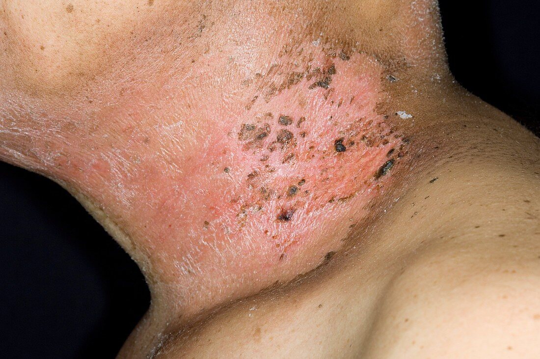 Post-radiotherapy skin damage