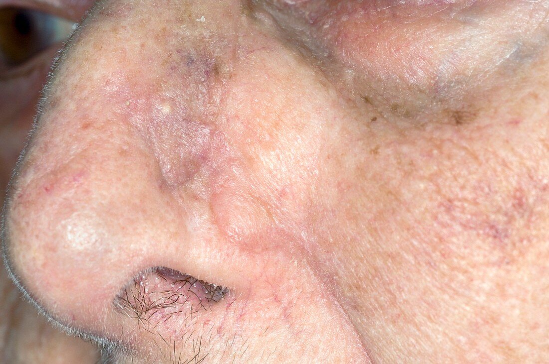 Excised skin cancer on the nose