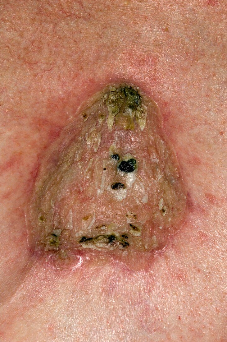 Basal cell skin cancer on the chest