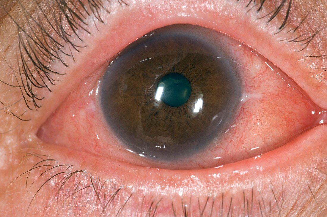 Allergic conjunctivitis of the eye