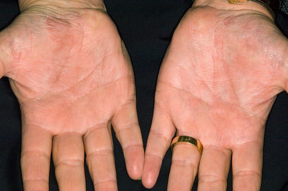 Psoriasis on the palm of the hands