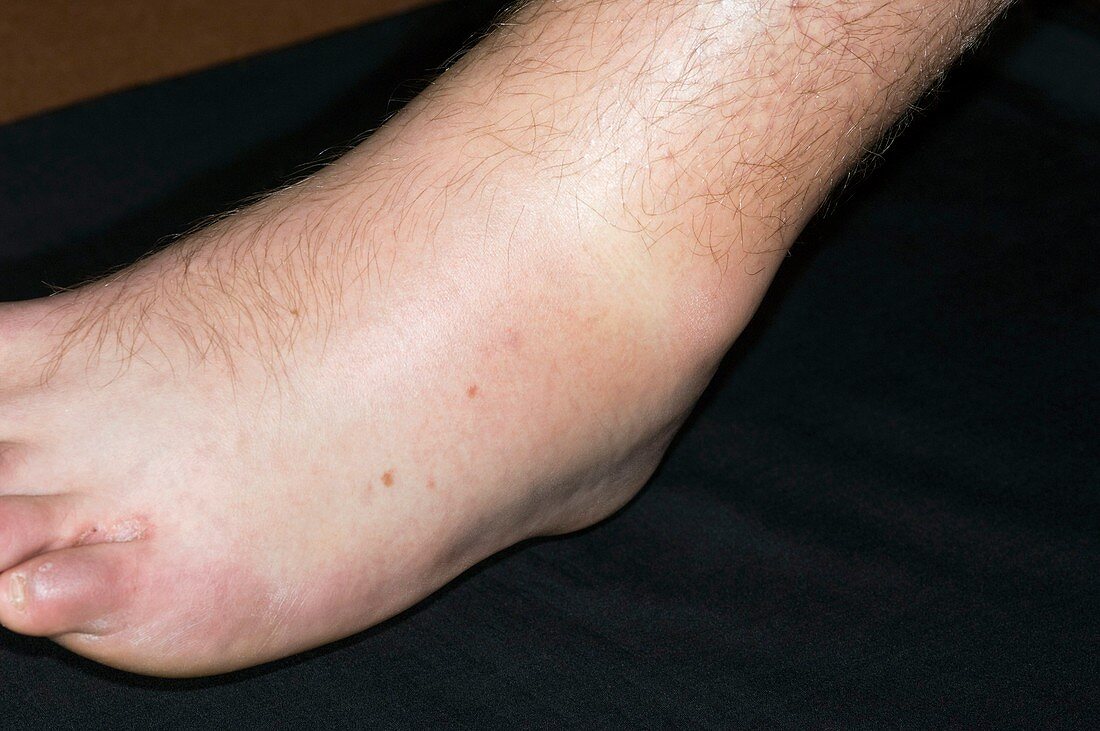 Sprained ankle playing sport
