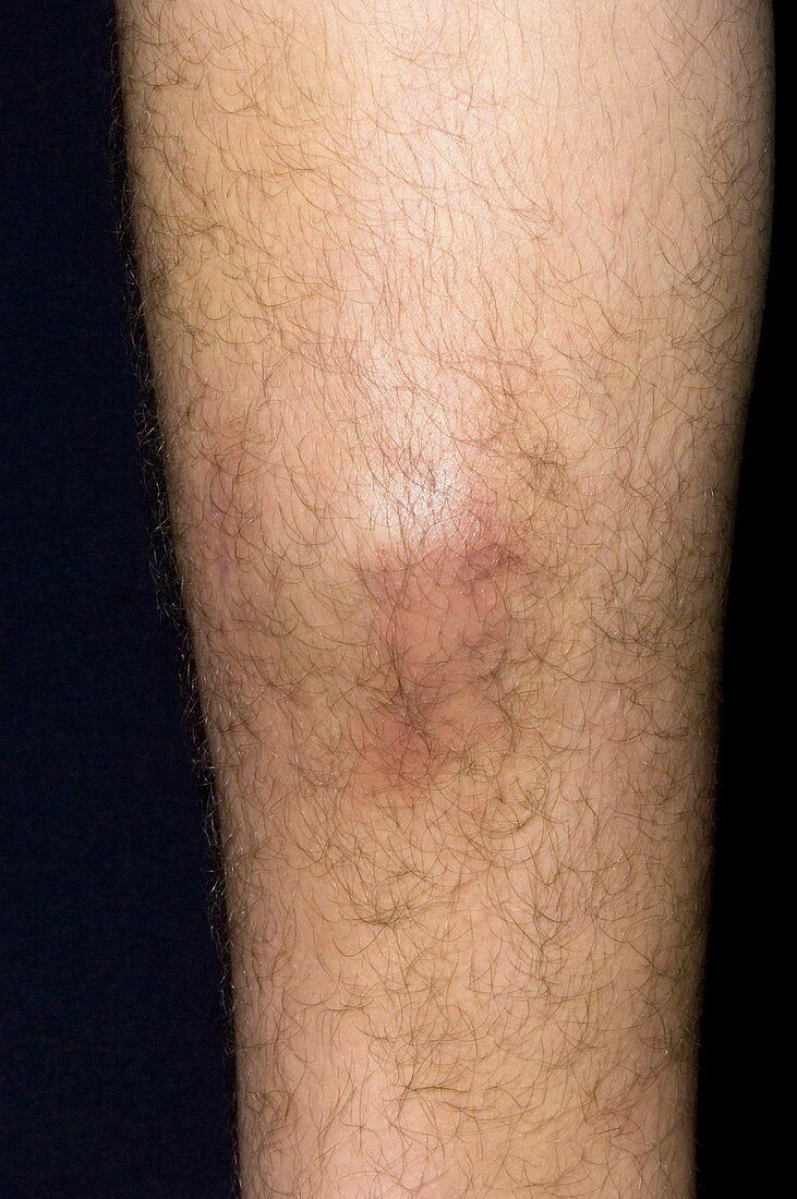 Bruised calf from playing sport