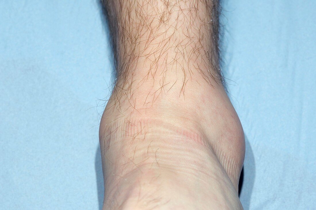 Sprained ankle playing sport