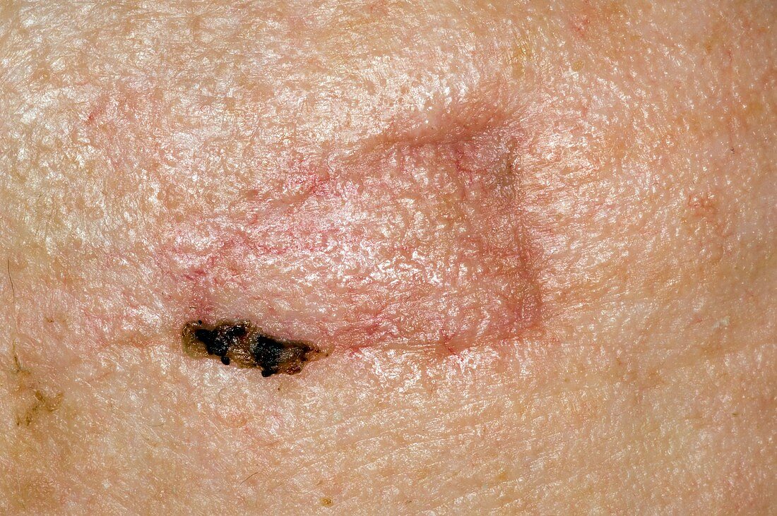 Scar on the skin after cancer removal