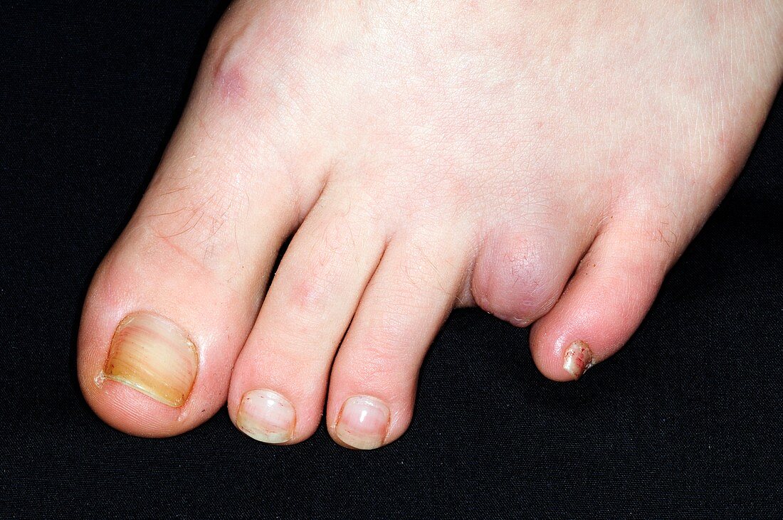 Amputated toe due to injury