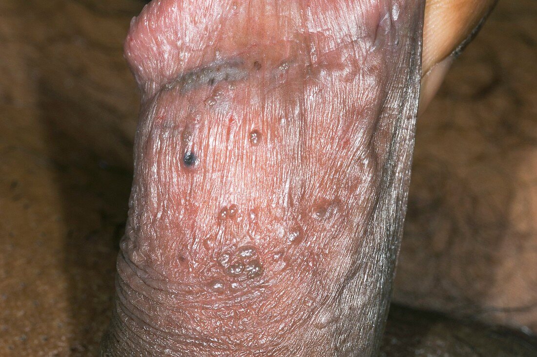 Warts on the penis