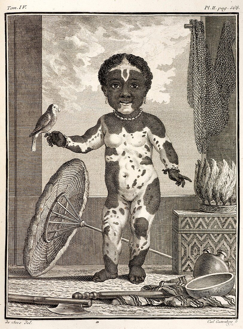 1777 African American Vitiligo Buffon