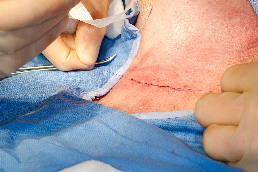 Parathyroid tumour surgery
